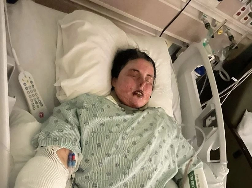 에밀리 맥앨리스터(30)는 항경련제 라모트리진을 처방받은 뒤 스티븐스-존슨 증후군에 걸려 시력을 잃었다. 더선 캡처