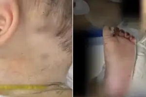 thumbnail - “10개월 아기 몸에 바늘 자국 600개” 엄마가 찔렀다…‘충격 이유’ 中 공분