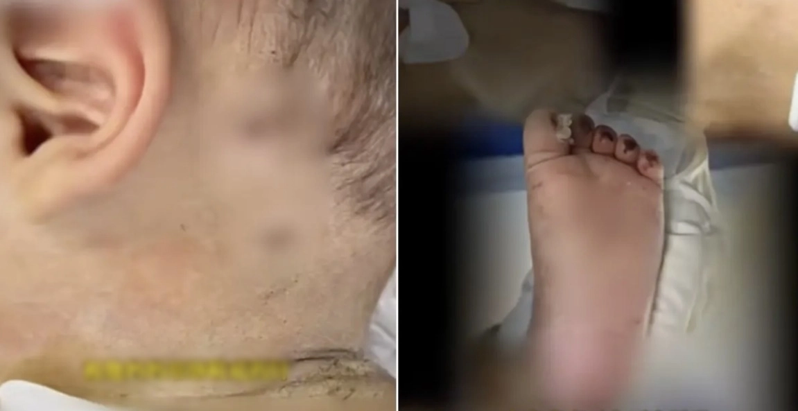 중국에서 생후 10개월 된 영아가 수백개의 바늘 자국으로 온몸이 뒤덮인 채 병원으로 급히 이송된 사건이 발생했다. 더우인 캡처
