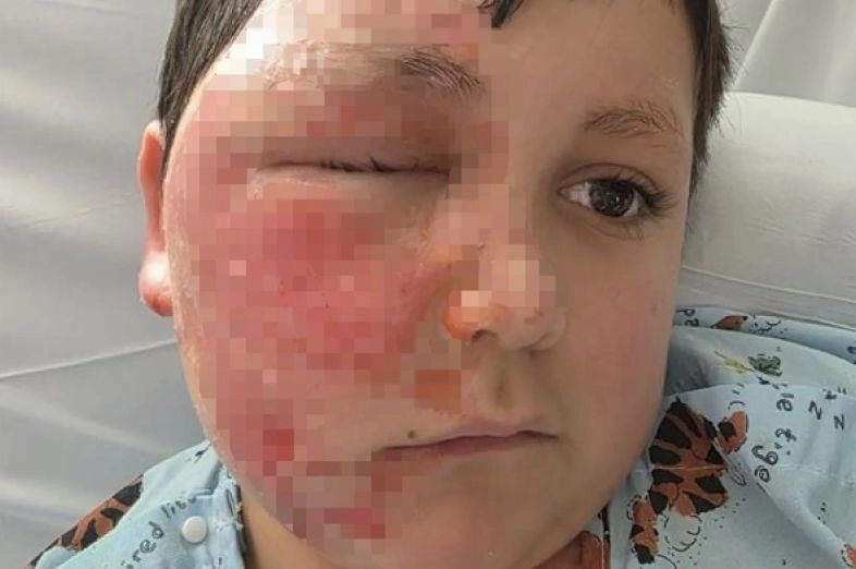 틱톡 유행을 따라한 9살 미국 소년이 심각한 화상을 입었다. 시카고 선타임즈 캡처