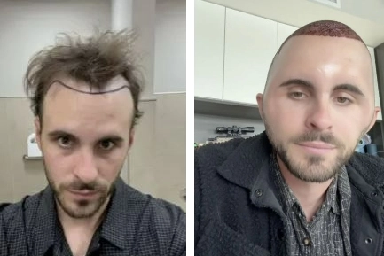 알렉스 핀켄의 모발 이식 수술 전 모습(왼쪽)과 “계란처럼 부었다”며 공개한 수술 후 모습. 소셜미디어(SNS) 캡처