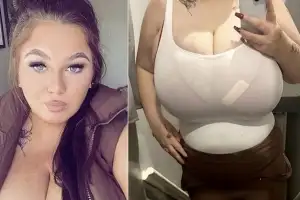 thumbnail - “가슴 무게만 32㎏” 피부 찢어져 패혈증까지…20대女 “축소술 거부당해”