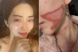 thumbnail - “예뻐지려 리프팅 600샷 받았다가…찢어지는 고통 2도 화상” 권민아 고통 호소