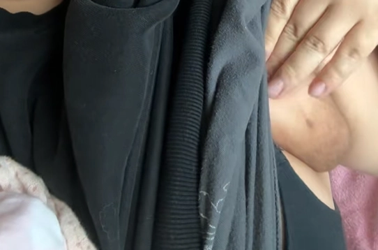 미국의 한 여성이 출산 후 겨드랑이 부위에 유두를 포함한 유방 조직이 발달한 희귀 사례를 공개해 온라인상에서 주목받고 있다. 틱톡 캡처