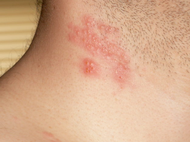 대상포진 관련 이미지. 기사와 직접 관련 없음. 위키피디아