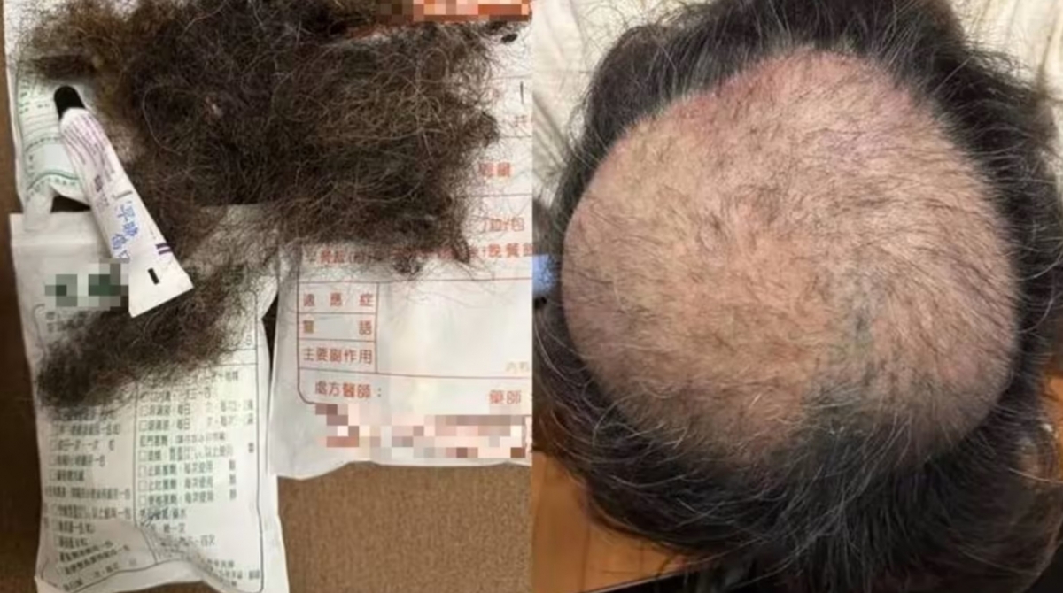 11일(현지시간) 대만 타이베이시 중산구의 한 주민이 인근 취두부 가게에서 풍기는 악취로 인해 극심한 스트레스를 받아 탈모에 이르렀다고 주장하며 게시한 사진. 2026.2.11 스레드
