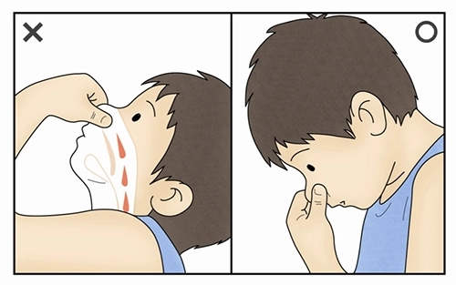 비출혈(코피) 응급 지혈법. 서울아산병원 제공