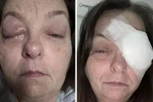 thumbnail - “눈에 ‘암’ 생길 줄이야”…시야 나타난 ‘검은 점’ 방치하다 결국