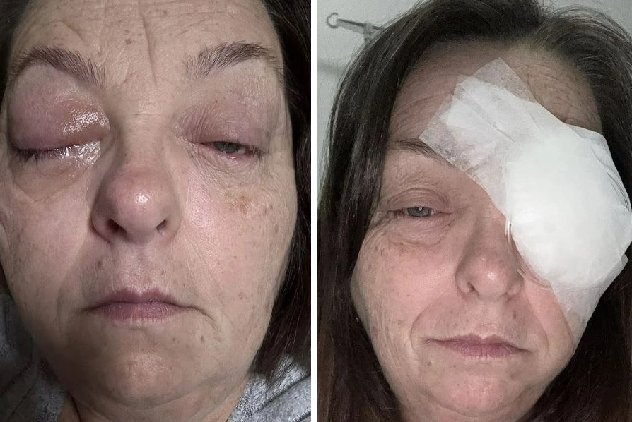 시야에 나타난 검은 점을 방치하다 맥락막 흑색종 판정을 받은 영국 장례 상담사 태미 잭슨(51). 데일리메일 캡처