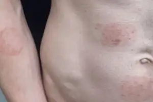 성관계로 퍼지는 ‘희귀 곰팡이’에 美 비상…“수건 같이 쓰다가도 옮는다”