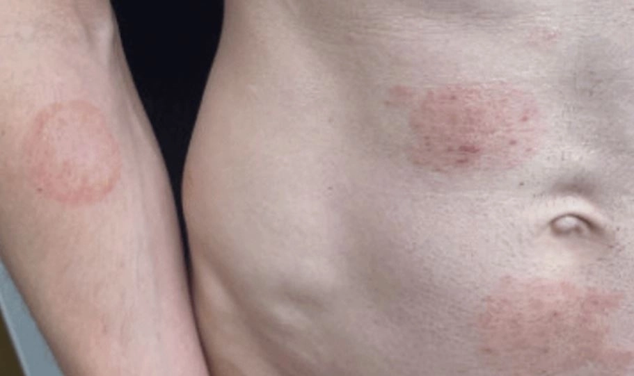 곰팡이균의 일종인 ‘트리코피톤 멘타그로피테스 7형’(TMVII)가 성관계를 통해 전파되는 것으로 확인됐다. 미국 질병통제예방센터(CDC)