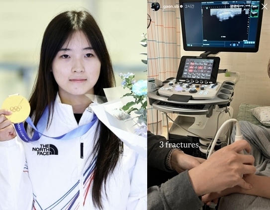 2026 밀라노·코르티나담페초 동계올림픽 스노보드 여자 하프파이프 금메달리스트인 최가온(왼쪽)이 자신의 소셜미디어(SNS)에 골절 부상을 암시하는 사진을 올렸다. 자료 : 뉴시스·최가온 인스타그램