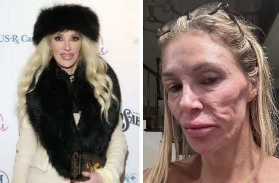 얼굴 변형으로 3년간 공개 활동을 중단했던 미국 방송인 브랜디 글랜빌. 소셜미디어(SNS) 캡처