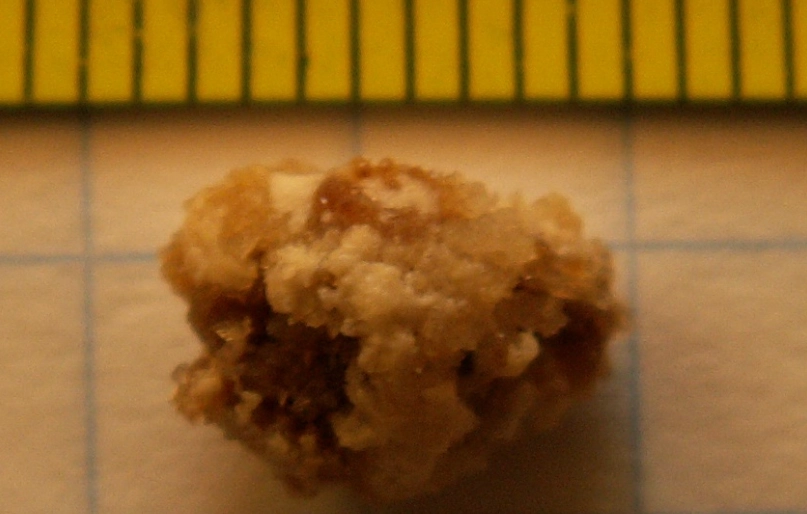 신장 결석 관련 이미지. 사건과 직접 관련 없음. 위키피디아