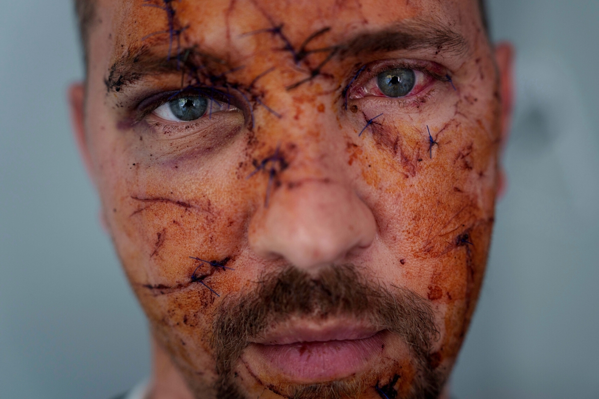 러시아군의 우크라이나 키이우 주택가 공습으로 다친 코스티안틴 비체크의 얼굴에 여러 군데 상처가 나 있다. 2025.4.25 키이우 AP 연합뉴스