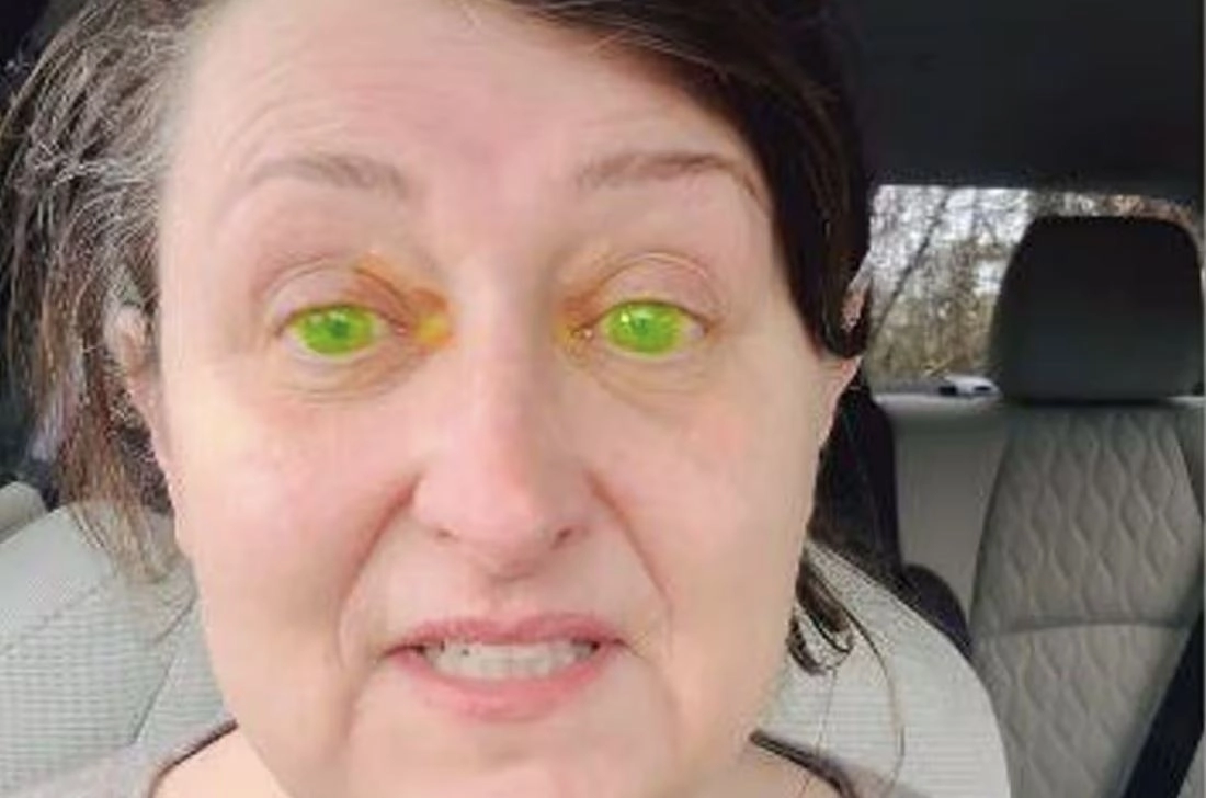눈동자가 형광 녹색으로 변한 아일랜드 여성 마가리타 워골라. 인스타그램(@margoinireland) 캡처