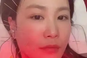 김지민 “욕실에서 넘어져 피부 함몰”…얼굴에 침만 수십 개