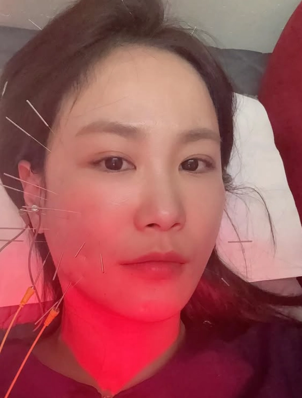 코미디언 김지민이 낙상 사고 후 치료 중인 근황을 공개했다. 인스타그램