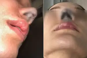 1800만원 코 성형했는데… “괴사 부작용, 숨쉬기 힘들어” 눈물로 호소한 태국 여성