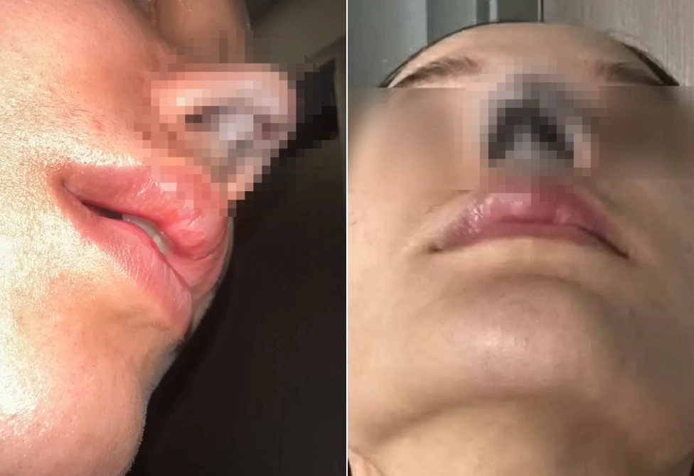 인플루언서로 활동하는 20대 태국 여성이 방콕의 한 성형외과에서 코 성형 재수술을 받았다가 괴사 등 부작용을 겪고 있다고 지난달 28일(현지시간) 기자회견에서 호소했다(사진 일부 모자이크 처리함). 채널7 보도화면 캡처