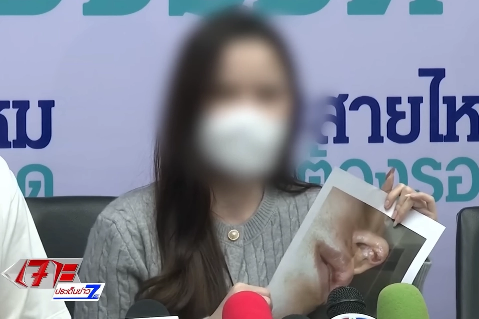 인플루언서로 활동하는 20대 태국 여성이 방콕의 한 성형외과에서 코 성형 재수술을 받았다가 괴사 등 부작용을 겪고 있다고 지난달 28일(현지시간) 기자회견에서 울먹이며 말하고 있다. 채널7 보도화면 캡처