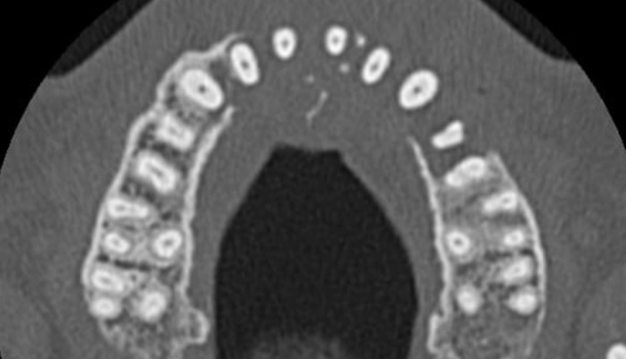 단순한 치통으로 여겼던 증상이 알고 보니 빠르게 진행되는 혈액암이었던 영국 남성의 사연이 전해졌다. 고펀드미(GoFundMe) 캡처