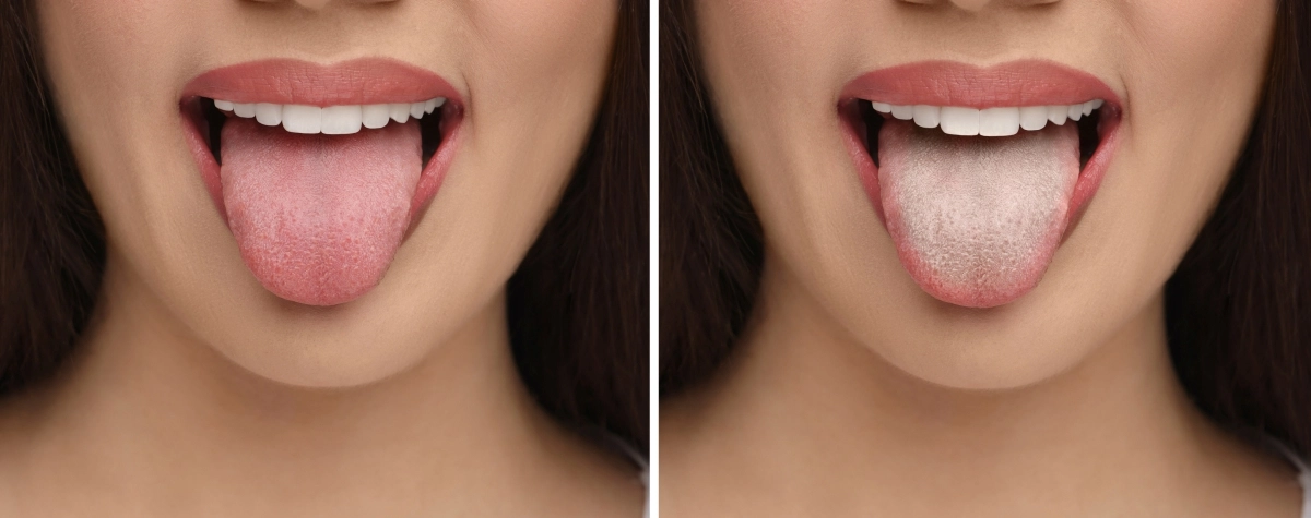 혀 클리너 사용 전(왼쪽)과 후(오른쪽). 설태 제거만으로도 구강 환경이 눈에 띄게 달라진다. 123rf