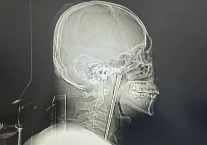 8년 전 술을 마시다 실수로 젓가락을 삼킨 왕씨의 목 엑스레이 사진. 금속 이물질이 목 안에 박혀 있는 모습이 선명하게 찍혔다. 바이두