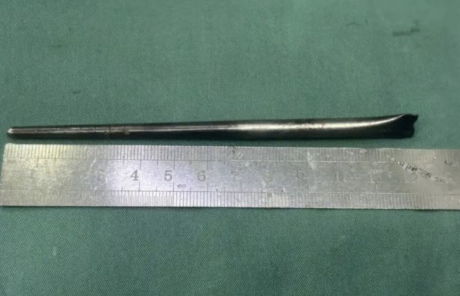중국 남성이 삼킨 12㎝ 길이의 금속 젓가락. 어떤 경위로 삼키게 됐는지는 정확히 알려지지 않았다. 바이두