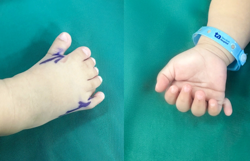 베트남에서 손가락과 발가락 개수가 정상보다 많거나 서로 붙어 있는 희귀 복합 기형을 가진 8개월 영아가 성공적으로 수술을 마친 사연이 전해졌다. 병원 제공