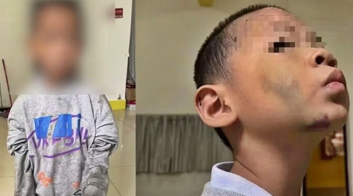 중화권 매체 중화망, HK01 등에 따르면 후난성 우강시 검찰은 최근 남매의 친부 A씨와 계모를 고의상해 및 아동학대 등 혐의로 구속 기소했다. 기소장에 따르면 이들 부부는 현재 15세와 5세인 남매를 상대로 2020년부터 2025년 3월까지 감금과 구타, 욕설, 굶기기 등 학대 행위를 반복한 것으로 드러났다. 우강시 공안국이 발표한 법의학 감정 결과, 막내아들(사진)의 신체 표면 약 47%에서 멍과 타박상이 관찰됐다. 2026.3.26 중화망