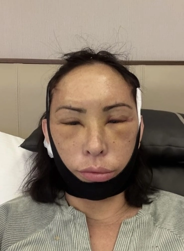 안면거상술을 받은 조조 맥기니스의 모습. 피플 캡처