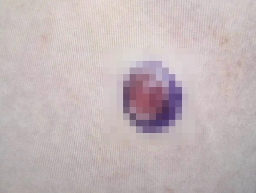 A군의 배에 자라난 뾰루지의 모습. A군을 진료한 의료진이 뾰루지 주변을 펜으로 동그랗게 표시했다. 자료 : 대만 따첸종합병원