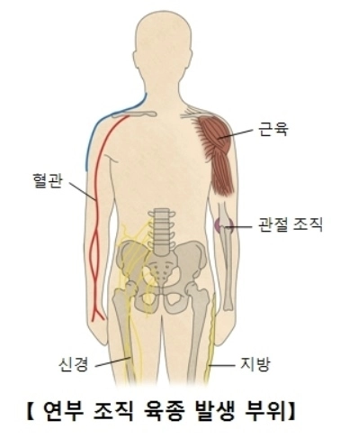 연부조직 육종이 발생하는 부위. 자료 : 서울아산병원