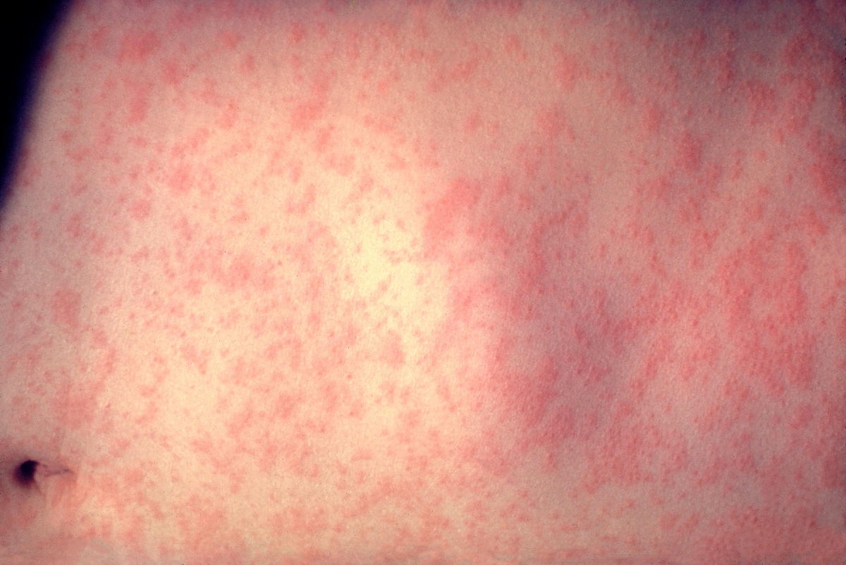홍역 감염 3일 된 환자의 피부 상태.  미국 질병통제예방센터(CDC) 제공