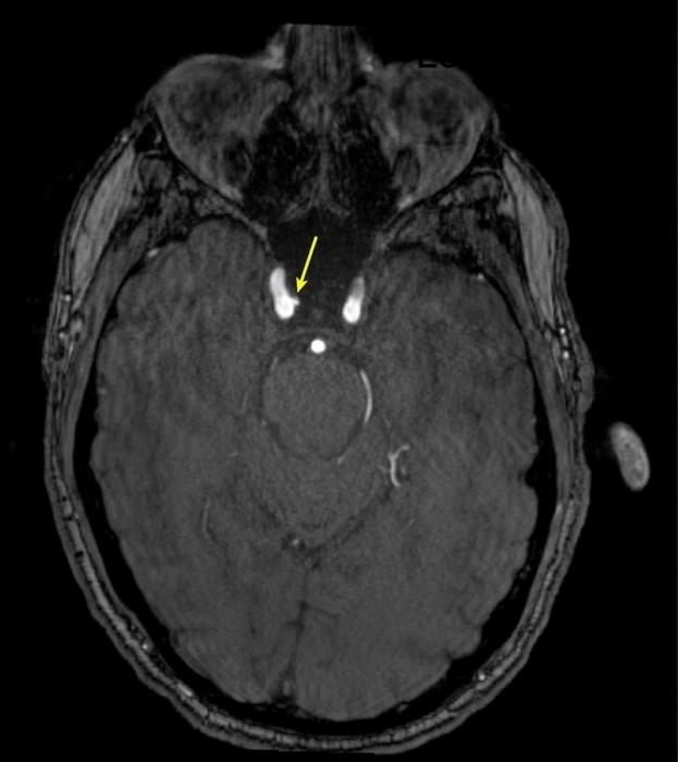 35세 남성 특수부대원의 뇌를 TOF-MRI 영상에서 뇌 동맥류(화살표)가 관찰됐다.  미국 방사선학회 제공