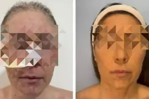 thumbnail - 항우울제 복용 후 피부 절반 잃은 40대…‘이것’ 덕분에 기사회생