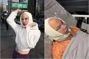 핀란드 인플루언서 “한국서 안면윤곽 수술…시력 상실 부작용” 폭로