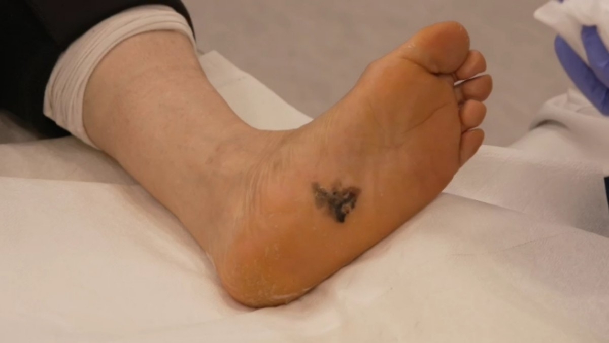 EBS ‘명의’에 나온 피부암 사례자