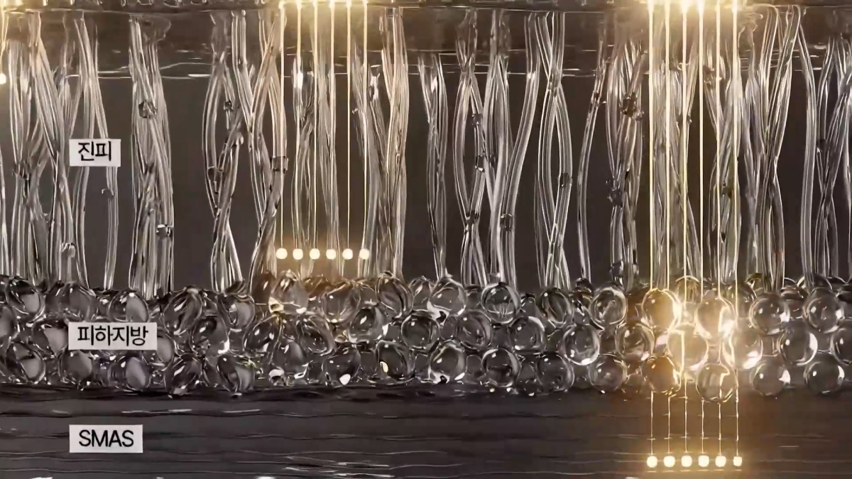 울쎄라의 원리를 설명하는 이미지. 출처 Merz Aesthetics Korea