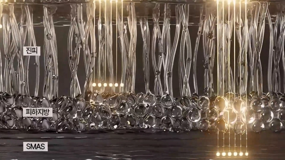 울쎄라의 원리를 설명하는 이미지. 출처 Merz Aesthetics Korea