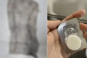 thumbnail - “자궁 시술 후 몸속에서 거즈 나와”…산부인과 의사 “제거 깜빡” 인정에도 ‘무혐의’