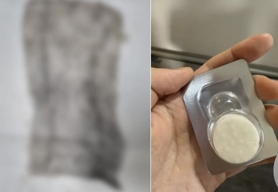 한 30대 여성이 산부인과 시술 후 몸속에서 거즈가 나와 시술 의사를 업무상 과실치상 혐의로 고소했으나 경찰이 무혐의 처분을 내렸다는 소식이 전해지며 논란이 되고 있다. MBC 뉴스 캡처