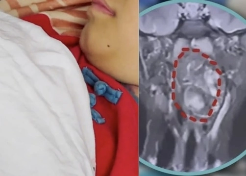 중국의 6세 남자아이 목에서 발견된 종양이 한때 ‘미발달 쌍둥이’로 오인돼 현지에서 큰 화제가 됐다. SCMP 캡처