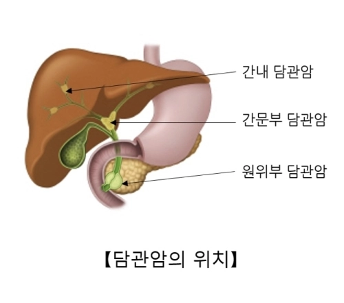 담관암. 자료 : 서울아산병원