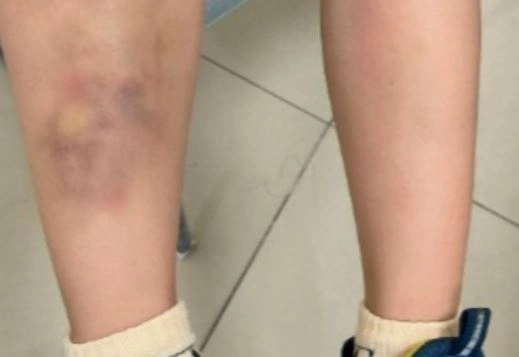 중국에서 생상추를 먹고 기생충에 감염돼 치료를 받은 6세 남아의 다리에 피멍이 들어 있다. 양성만보 캡처