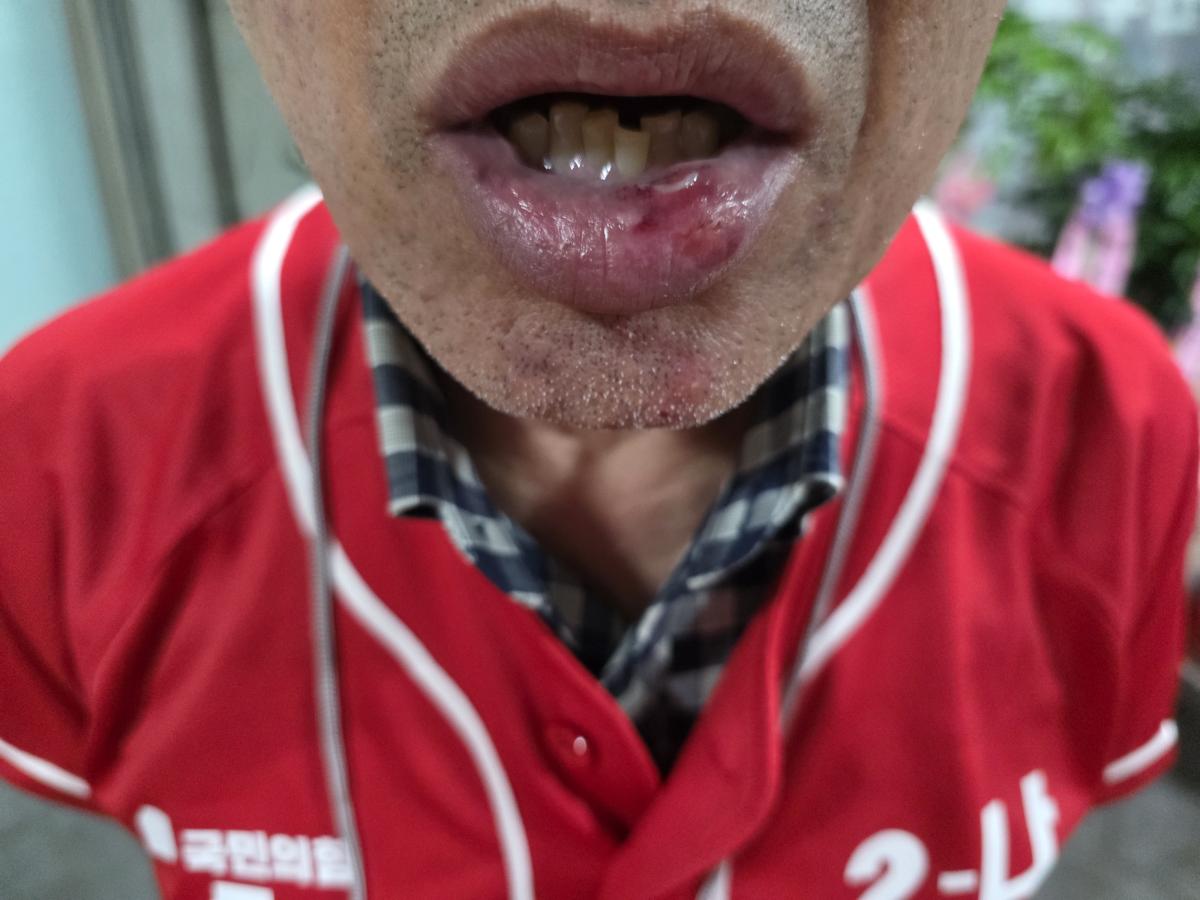 지난 21일 오후 대구 수성구 범물동에서 선거운동을 하던 중 신원을 알 수 없는 남성에게 폭행을 당한 박새롬 국민의힘 수성구의원 후보의 선거운동원 A씨가 입술이 찢어지고 턱이 부어오르는 부상을 입었다. 박새롬 수성구의원 후보 제공