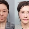 thumbnail - “젊어졌다 난리” 62세 유혜리, 확 달라진 외모…연예인 빠진 ‘안면거상’ 뭐길래