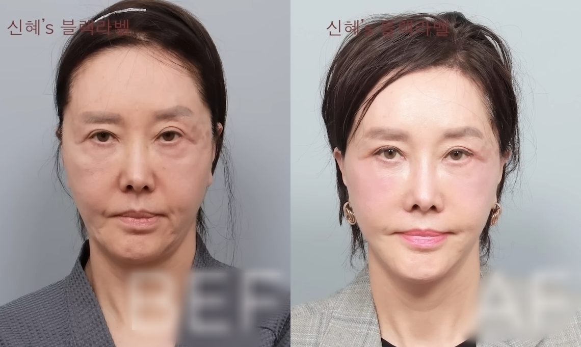 배우 유혜리가 안면거상 수술을 받은 뒤 달라진 외모를 공개했다. 유튜브 채널 ‘BLACKLABEL: 하이엔드메이크오버쇼’ 캡처