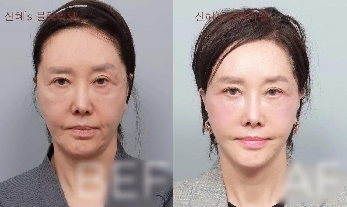 배우 유혜리가 안면거상 수술을 받은 뒤 달라진 외모를 공개했다. 유튜브 채널 ‘BLACKLABEL: 하이엔드메이크오버쇼’ 캡처
